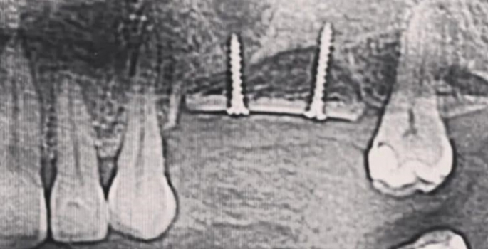 Özbaylar; Kemik yetersizliğinde implant mümkün