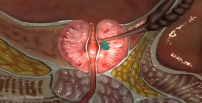 Uzmanlar uyarıyor: 40 yaş üstü risk altında